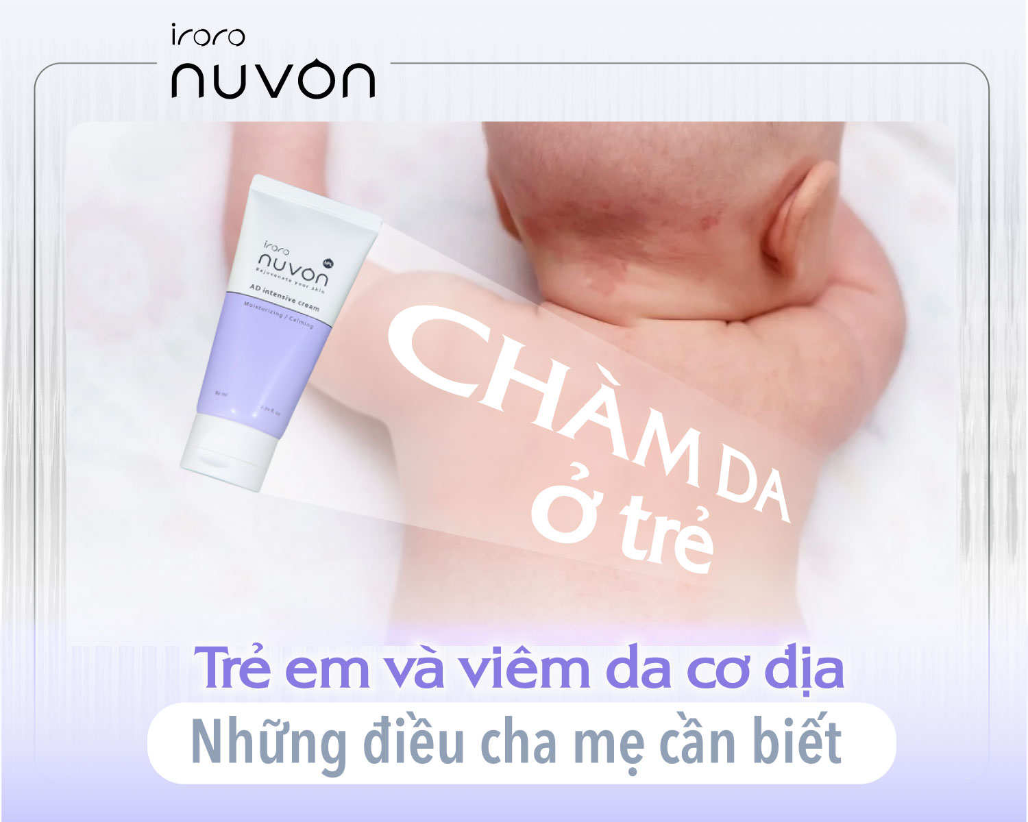 Chàm da trẻ em viêm da cơ địa trẻ em Chàm da trẻ em viêm da cơ địa trẻ em